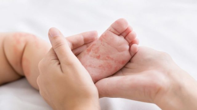 ilustrasi campak pada anak foto : shutterstock