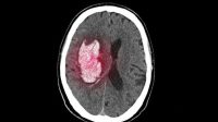 Ilustrasi pendarahan otak. Foto: ilustrasi